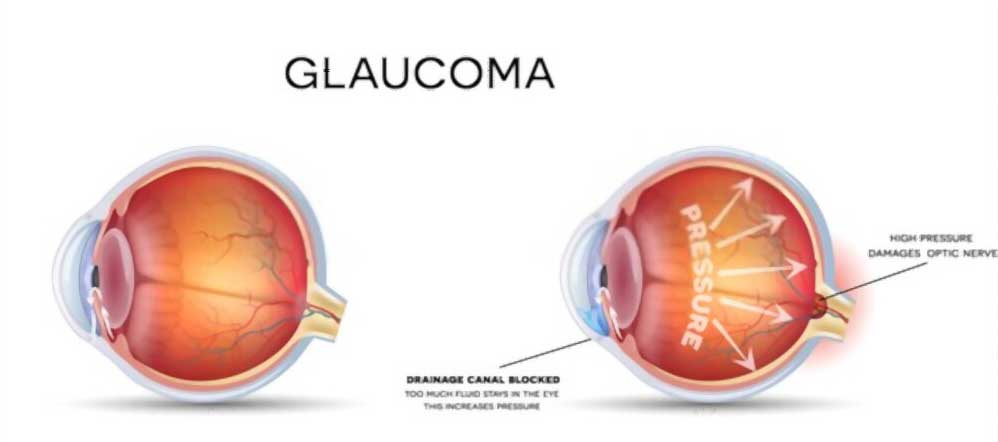 Glaucoma